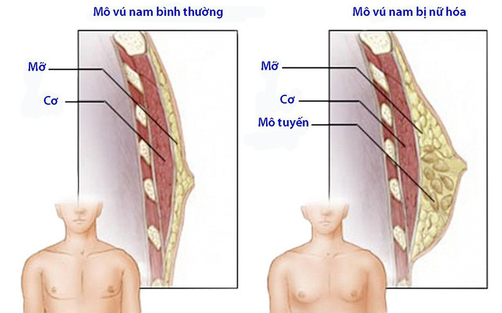 Người đàn ông bị nữ hóa tuyến vú - Ảnh 3.