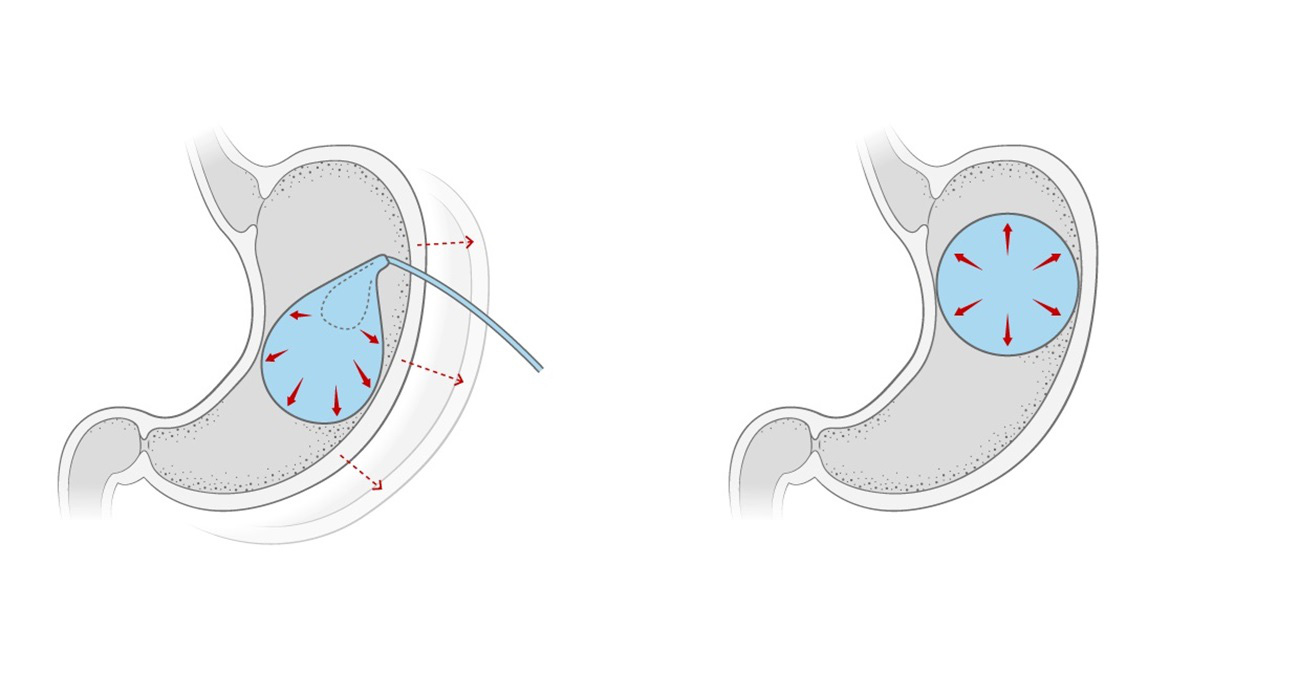 Chế tạo bóng dạ dày giúp giảm cân lâu dài - Ảnh 2.